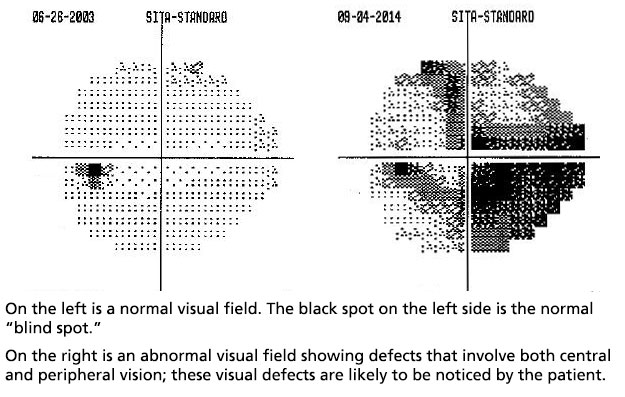 Infographic of Visual field testing